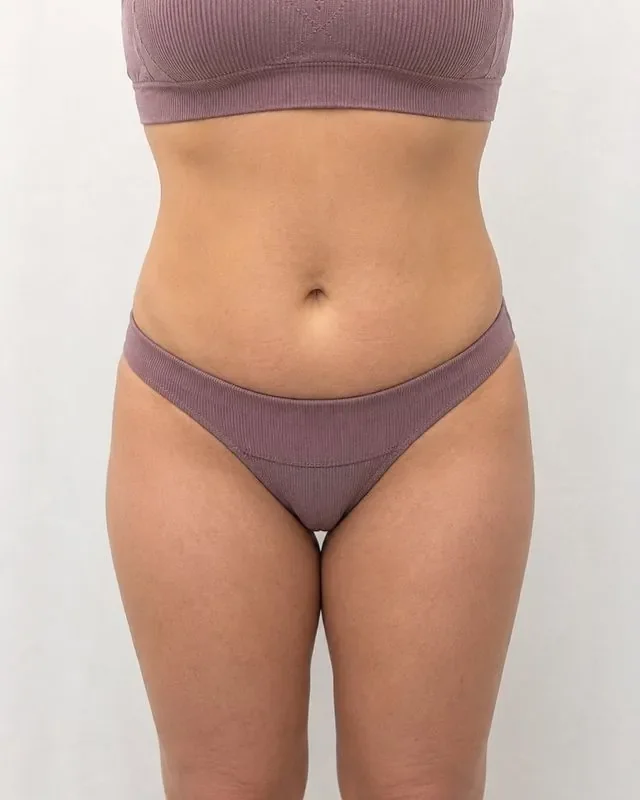 After X-Freeze fat freezing on the abdomen, 4 sessions