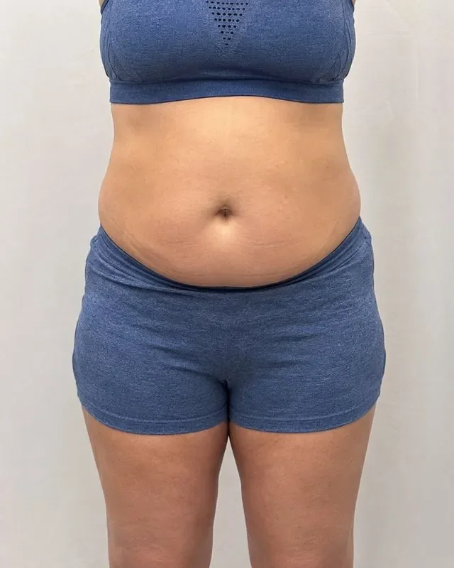 Before X-Freeze fat freezing on the abdomen, 4 sessions